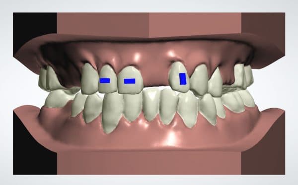 Digital clear aligner treatment design